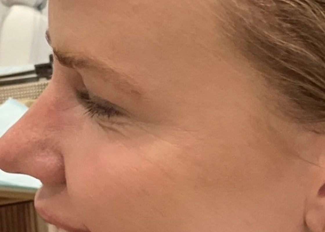 After Dysport: the same outer eye in profile with the crow's feet softened and the skin smooth