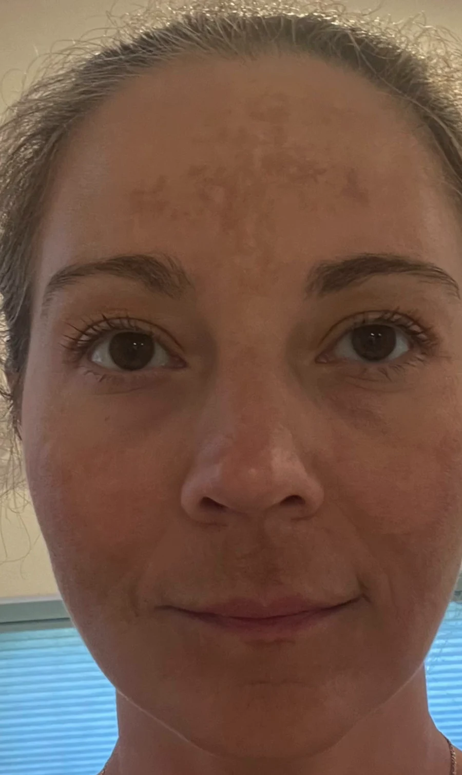 Before: uneven pigment across the forehead, visible texture and fine expression lines