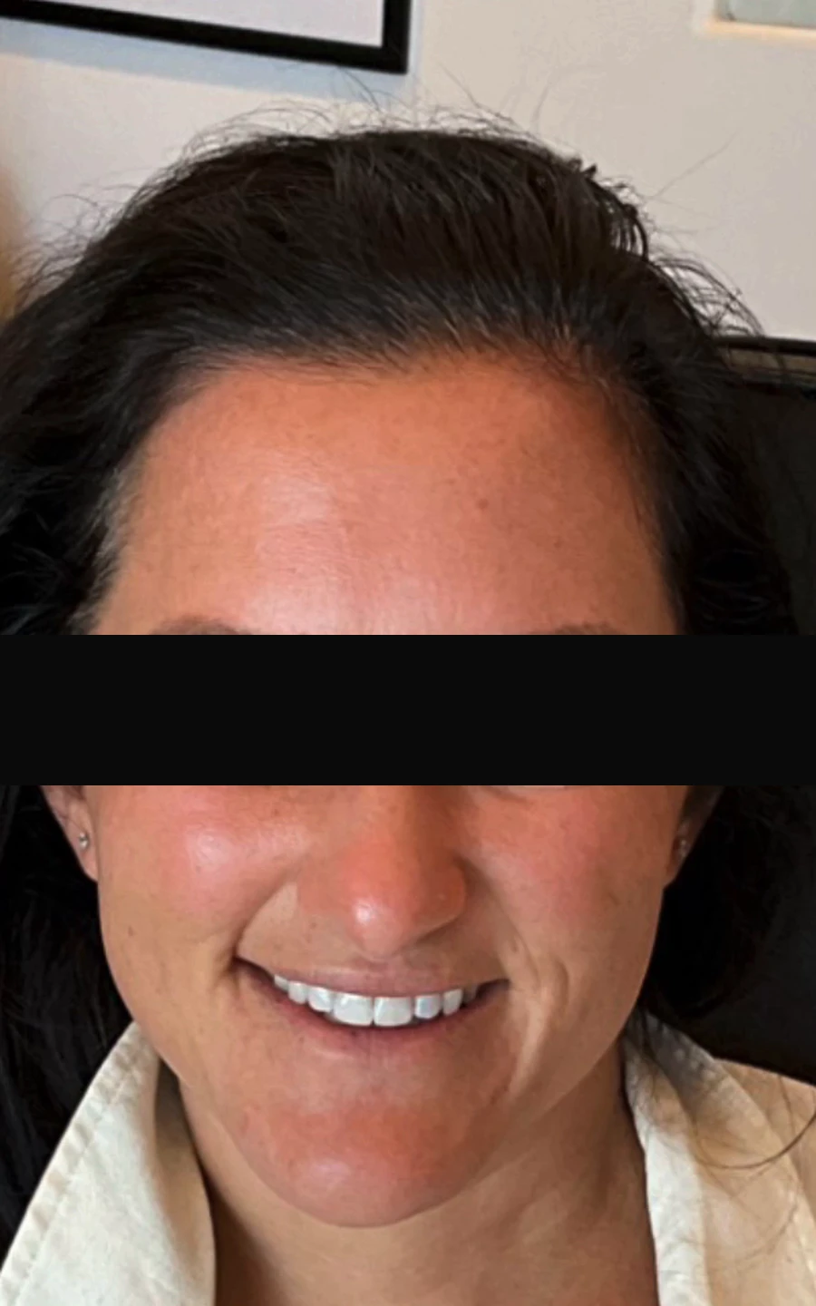 After a series of microneedling treatments: skin texture is smoother and tone is more even across the cheeks and chin