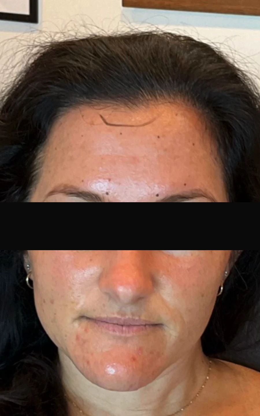 Before microneedling: uneven skin texture, visible congestion and redness across the cheeks and chin