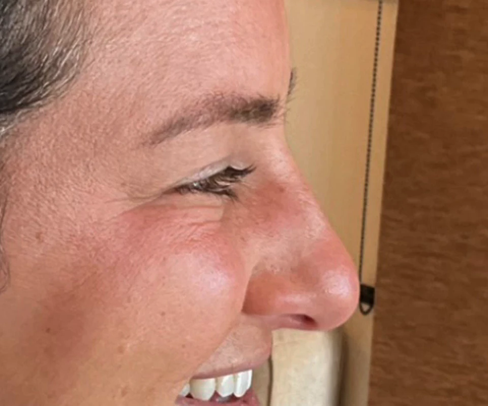 Two weeks after Dysport: the same guest smiling with the crow's feet softened, the smile unchanged