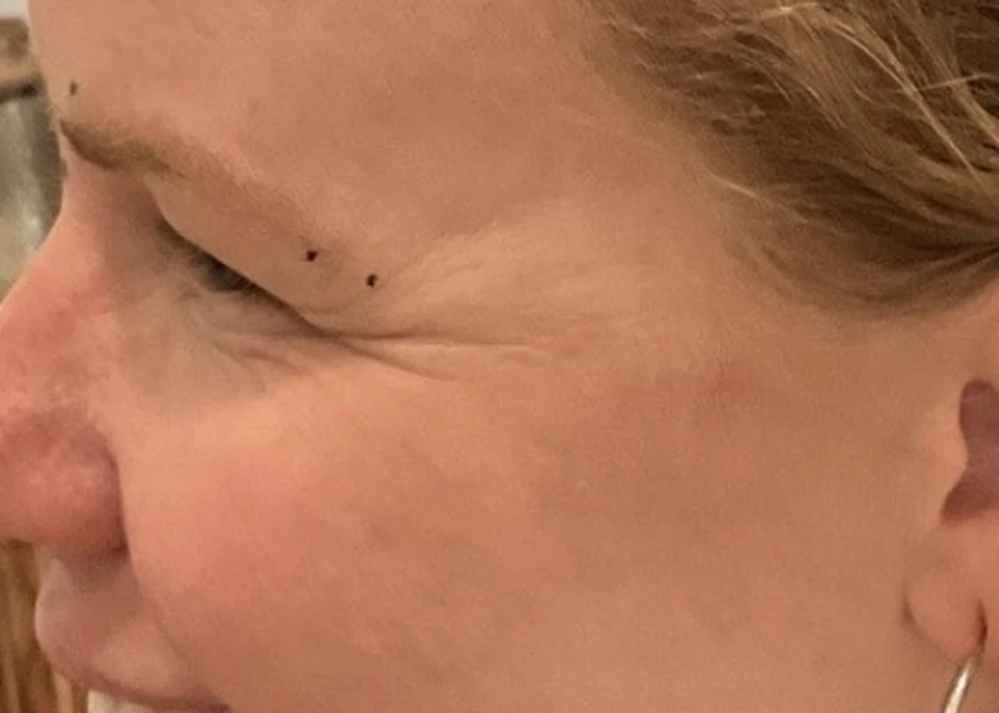 Before Dysport: crow's feet fanning from the outer corner of the eye with injection points marked, photographed in profile