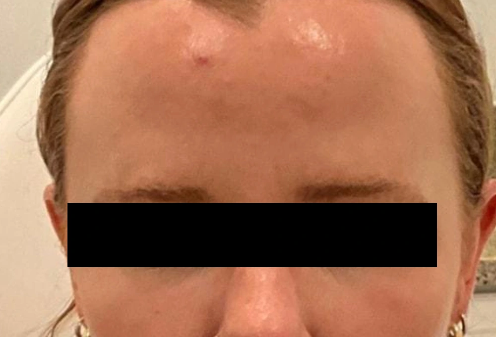 Two weeks after Dysport: the same guest furrowing with the frown lines and forehead lines smoothed, brows still mobile