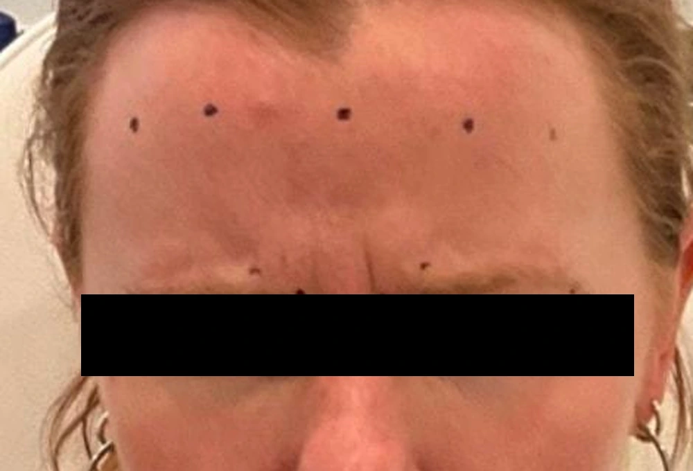 Before Dysport: frown lines between the brows and horizontal forehead lines visible while the guest furrows, with injection points marked